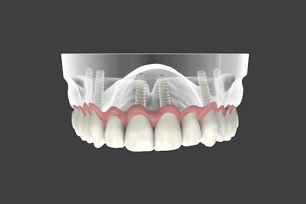 Are Implant Supported Dentures Permanent from Paramount Dental Care & Specialty in Long Beach, CA