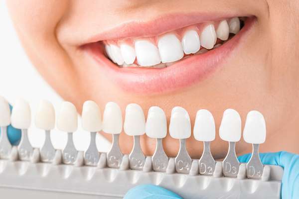 Ask a Cosmetic Dentist: What Are Veneers from Paramount Dental Care & Specialty in Long Beach, CA
