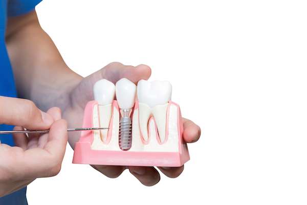 Can You Get Dental Implants if You Have Gum Disease from Paramount Dental Care & Specialty in Long Beach, CA