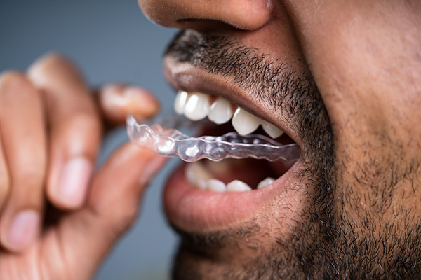 A Cosmetic Dentist Explains Benefits of Clear Aligners from Paramount Dental Care & Specialty in Long Beach, CA