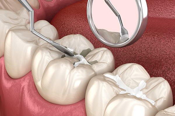 When Are Dental Sealants Recommended By A General Dentist?