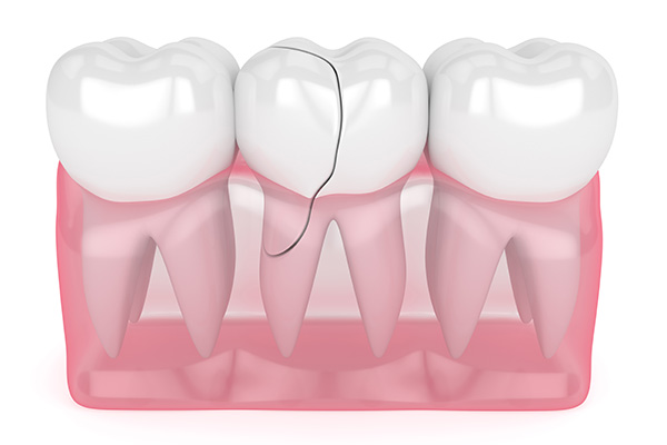 How A General Dentist Can Repair A Damaged Tooth