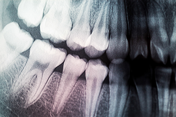 What General Dentistry Exams May Find In An X Ray Diagnosis