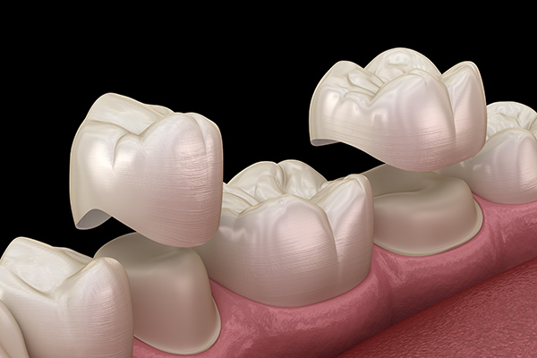 Popular General Dentistry Procedures for Damaged Teeth: Dental Crowns from Paramount Dental Care & Specialty in Long Beach, CA