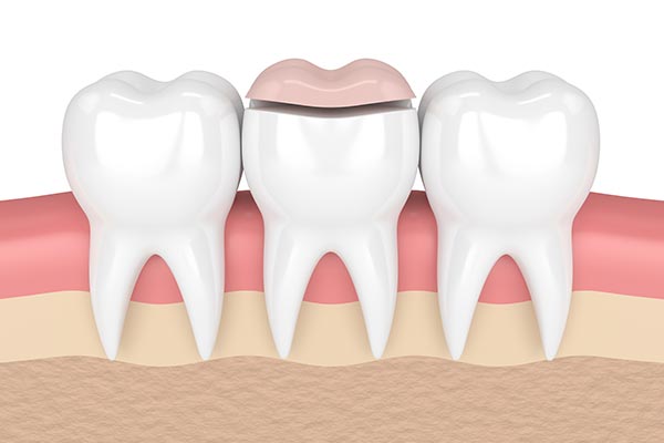 How a Cosmetic Dentist Can Place Inlays and Onlays from Paramount Dental Care & Specialty in Long Beach, CA