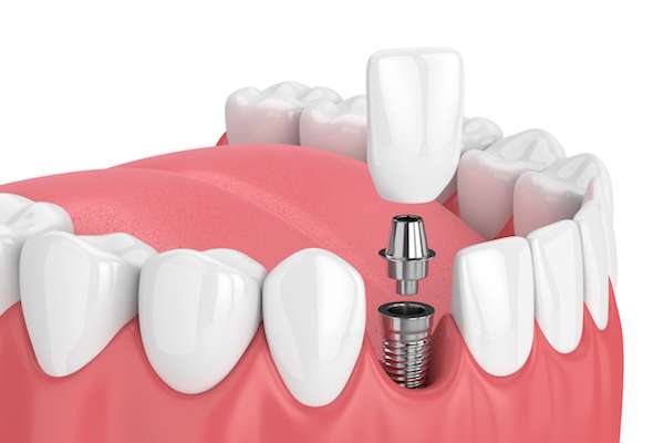 How Painful is Dental Implant Surgery from Paramount Dental Care & Specialty in Long Beach, CA