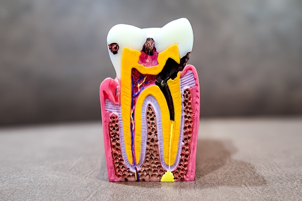 How Implant Crowns Can Restore Your Smile