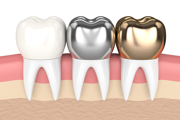 Metal Crowns vs. Porcelain Dental Crowns from Paramount Dental Care & Specialty in Long Beach, CA