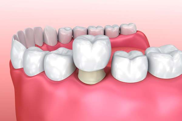Permanent Dental Crowns vs. Temporary: Is There a Difference from Paramount Dental Care & Specialty in Long Beach, CA