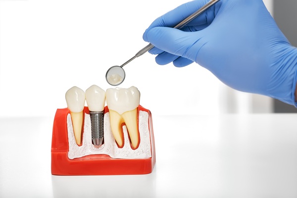 Root Canal Treatment: What To Expect And How It Saves Your Smile