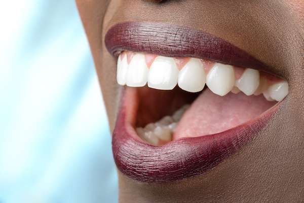 Routine Dental Care: What Are Tooth Colored Fillings from Paramount Dental Care & Specialty in Long Beach, CA