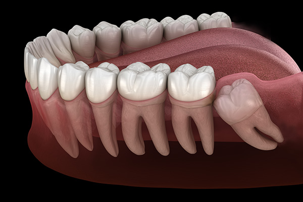 Wisdom Tooth Extraction from Your General Dentist from Paramount Dental Care & Specialty in Long Beach, CA